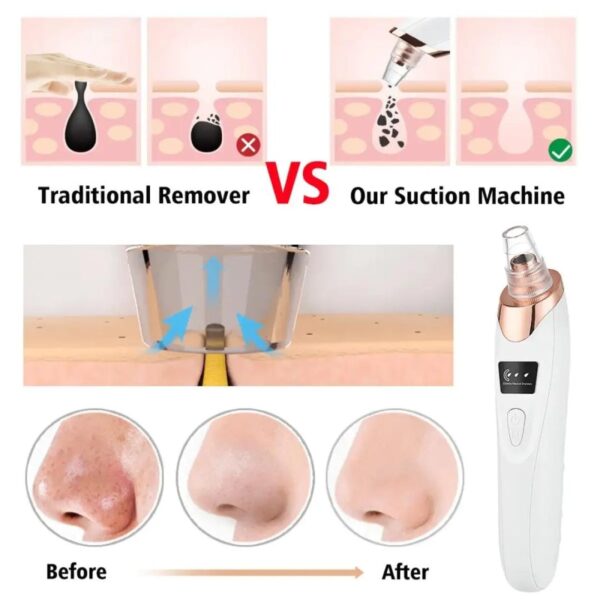 Newest Blackhead Remover Pore Vacuum, Upgraded Facial Pore Cleaner-5 Suction Power, USB Rechargeable Blackhead Vacuum Kit Electric Acne Extractor Tool for Women & Men - Image 4