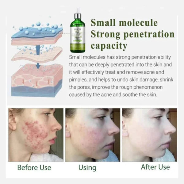 MUICIN Tea Tree Anti Aging Clear Skin Face Serum. - Image 4