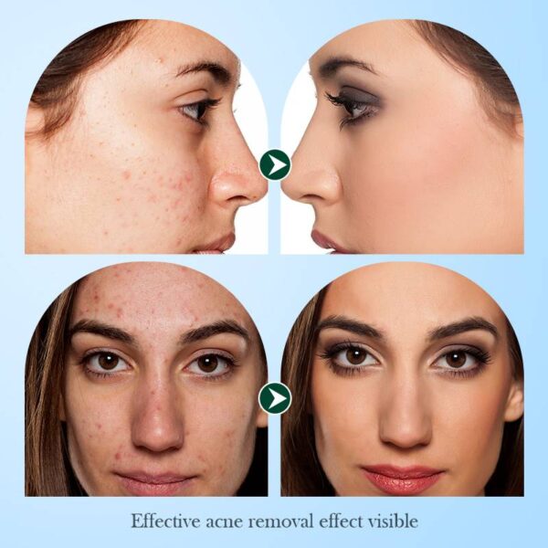 Sadoer Tea Tree Acne Oil Control Anti-Acne Facial Sheet Mask. - Image 2