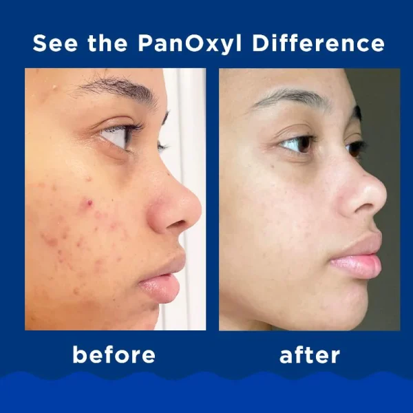PanOxyl, Acne Creamy Wash, Benzoyl Peroxide 4% Daily Control - Image 5